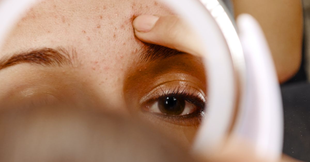 What you need to know about forehead acne, according to dermatologists