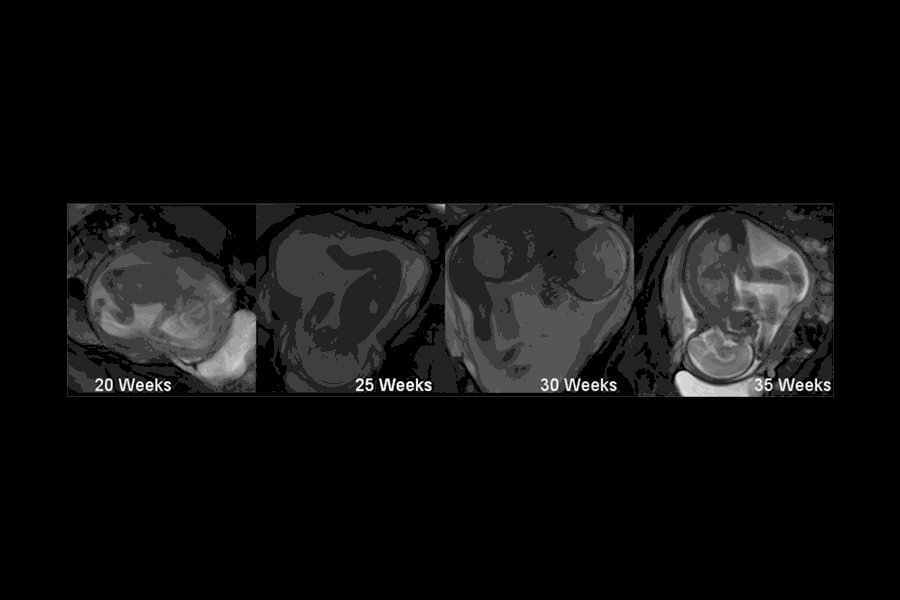 A new study is the first to quantify babies' kick forces in the womb. Above, an animation made from MRI scans showing fetal kicks at various stages of development.