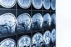 MRI images of the brain.