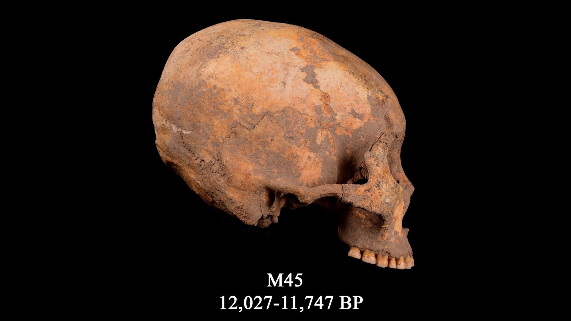 12,000 Years Ago, a Boy Had His Skull Squashed into a Cone Shape 
