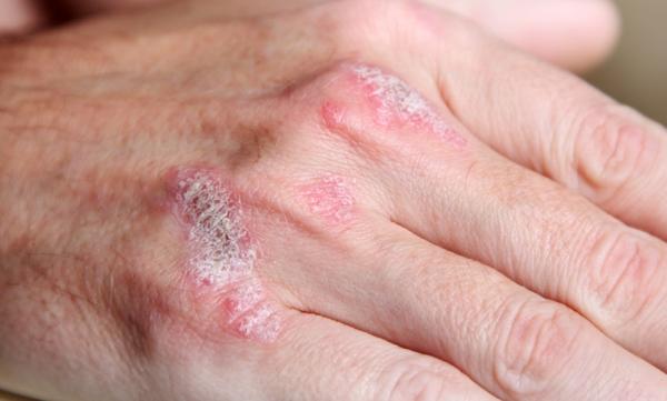 does psoriasis go away completely)
