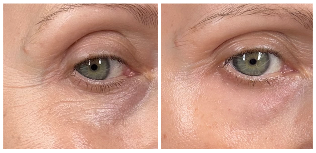 Shiseido Vital Perfection Before &amp;amp; After