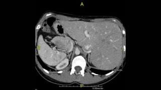 Black and white CT scan of the cross-section of a person's body against a black background.