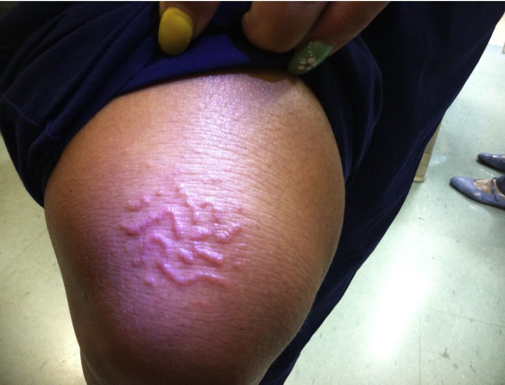 weird rash, cutaneous larva migrans