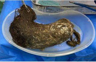 A giant hair ball, known medically as a trichobezoar, was removed from the teen's stomach. The hair ball "formed a cast of the entire stomach," the authors noted.