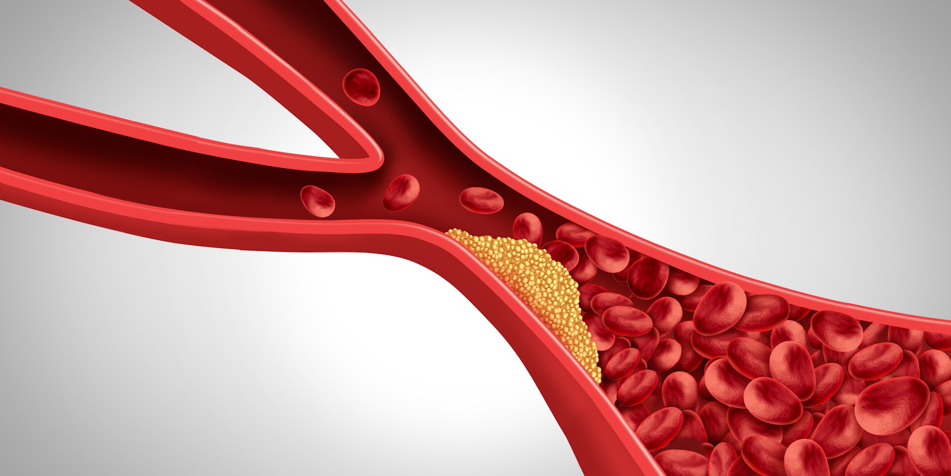 Three-dimensional concept of fatty plaque buildup in an artery.