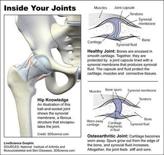 A graphic shows what's inside your joints, and what can go wrong.