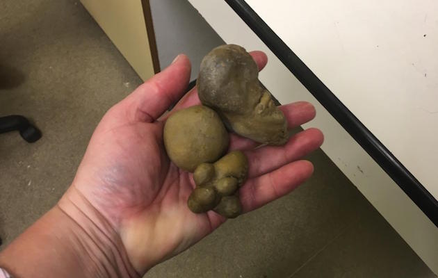 KidneyStones