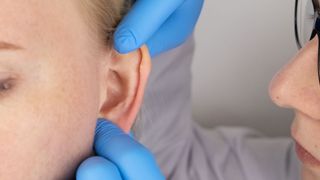 a gloved doctor holds a patient's ear, displaying an example of a darwin's point on the outer cartilage