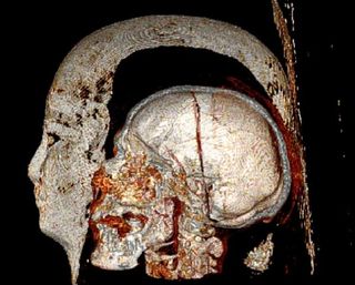The ancient Egyptian mummy Djeher as imaged with a CT scanner. Djeher was found to have heart artery and other vascular disease.