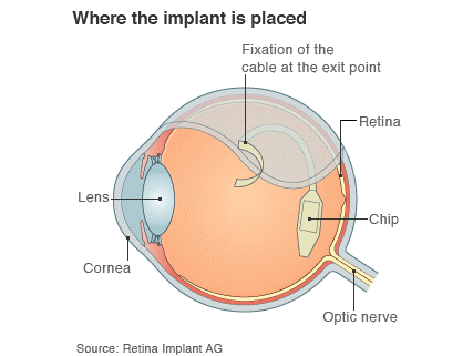 New retinal implant tech gives basic vision to blind people