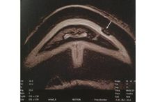 MRI-scan-showing-site-of-keratoma.jpg