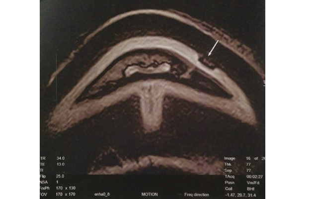 MRI-scan-showing-site-of-keratoma.jpg