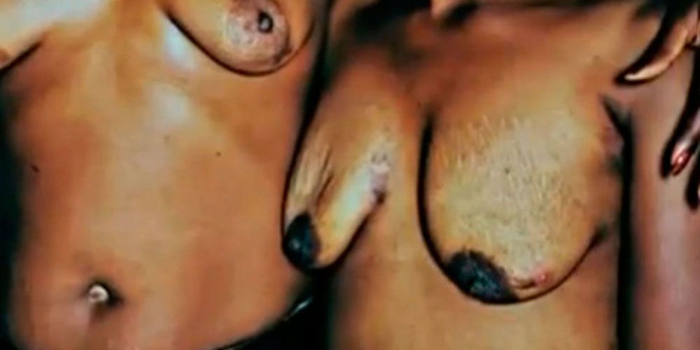 breast ironing