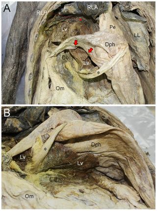 A hernia (arrows) showed up on the right side of the diaphragm during dissection of the Korean mummy. The left part of the diaphragm (B) shows no signs of any defect, the researchers said.