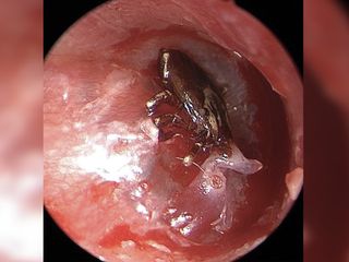 A 9-year-old boy who heard a buzzing sound in his ear turned out to have a tick attached to his eardrum. Above, an image of the tick inside the boy's ear.