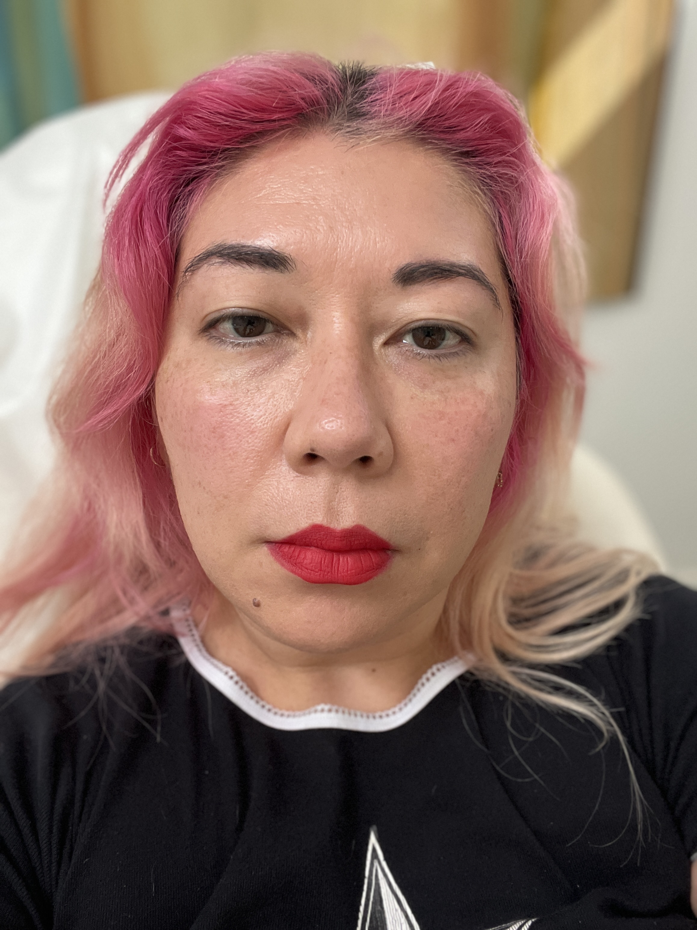 10 days after Skinvive