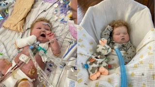 Easton Sinnamon is the first person to receive a heart transplant along with implantation of thymus tissue from the same donor. On the left, Easton after his heart transplant; on the right, Easton at home during his first week out of the hospital.