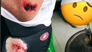A close-up of Froome's road rash