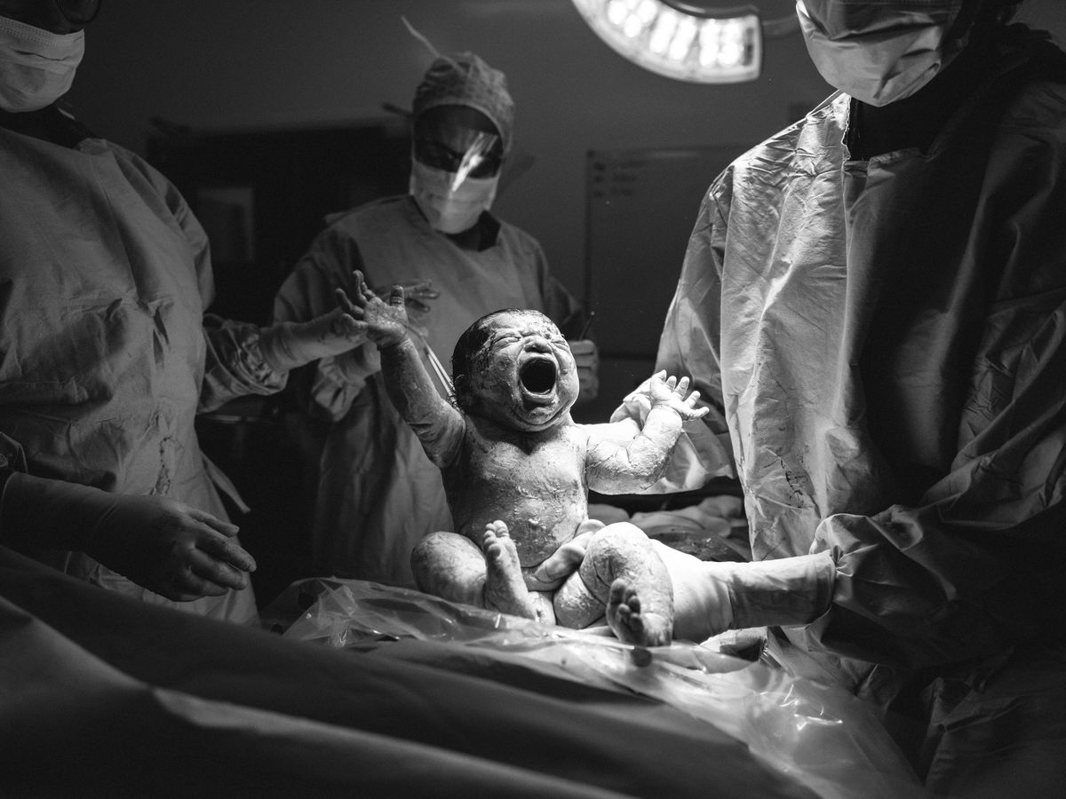 a child being born in an operating theatre