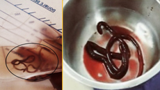 Urobag showing the worm (left), The worm in a tray (right).