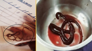 Urobag showing the worm (left), The worm in a tray (right).