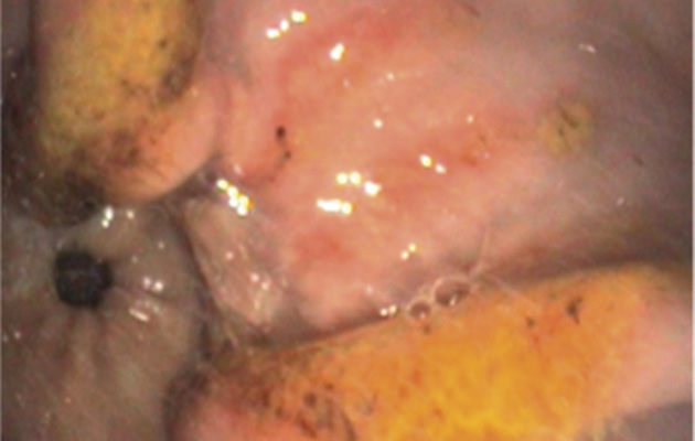 Glandular ulcer