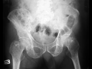 pelvic x-ray, x ray, xray, chronic pain