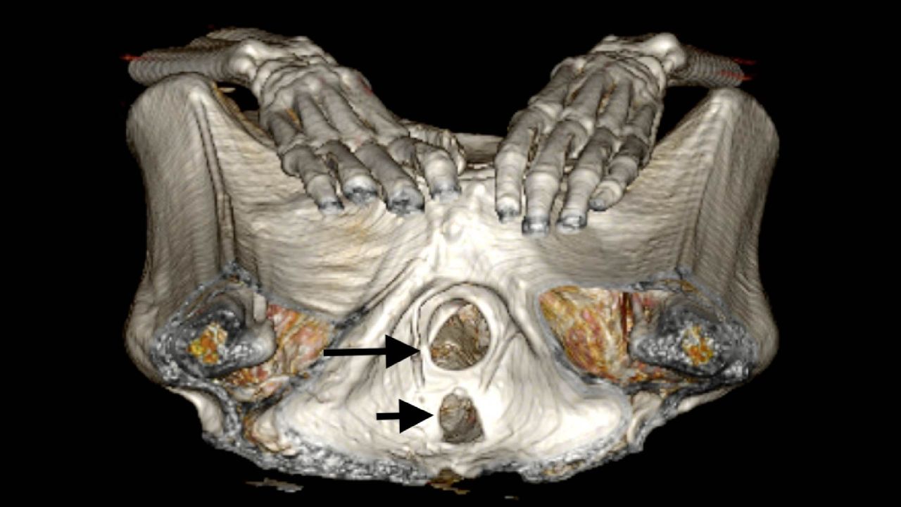 ct scan of the screaming woman pubic bones