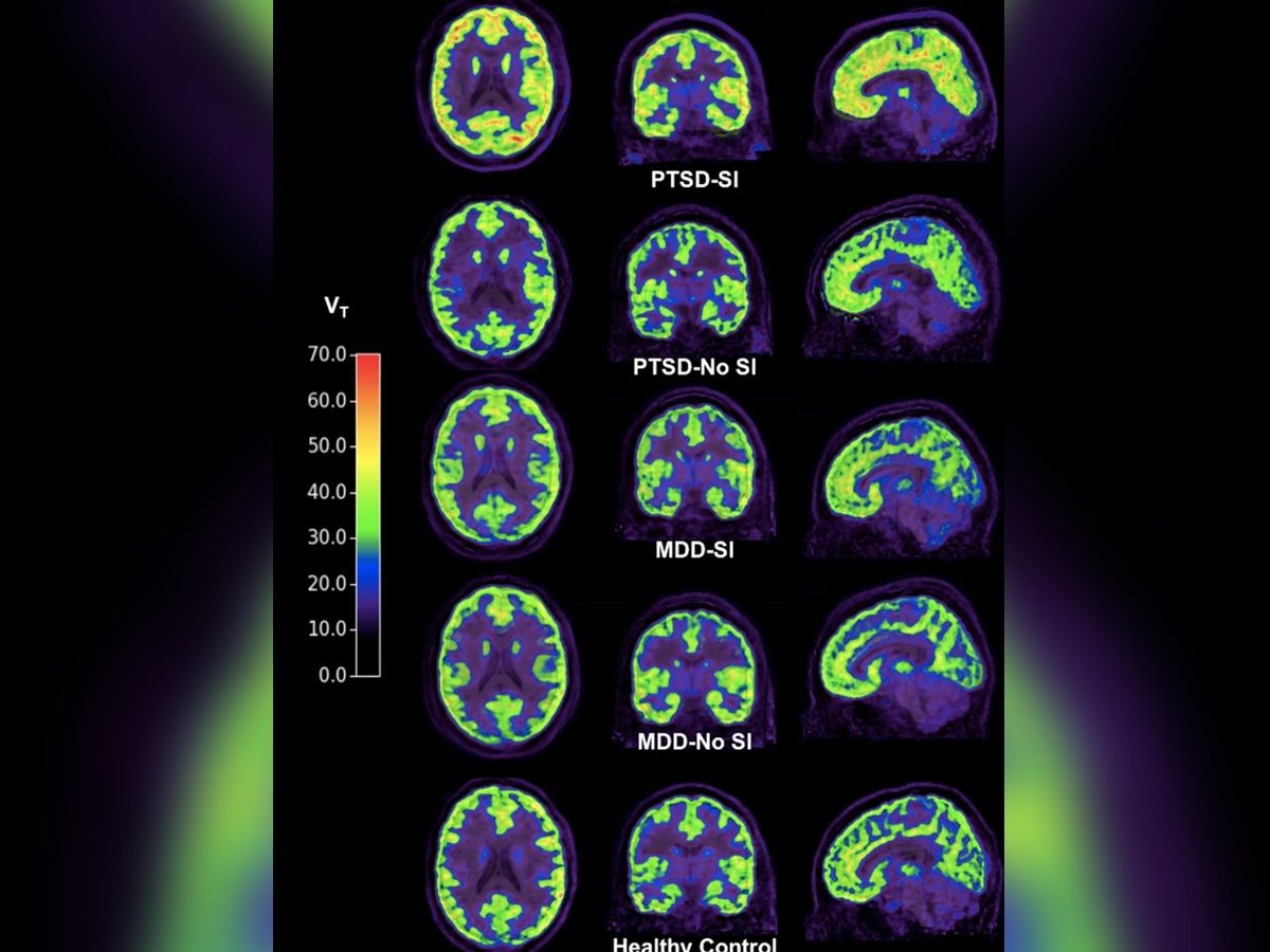 Brain Scans Reveal Potential Biomarker of Suicidal ...