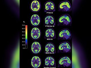 Researchers may have found a biomarker for suicidal thoughts in the brains of people with PTSD. Above, brain scan images show higher levels of the brain receptor mGluR5 in people with PTSD with suicidal ideation (SI), compared with other groups, including