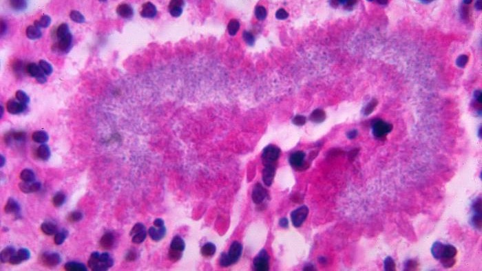 This rare bacterial infection triggers pus-filled sores in the lungs and brain