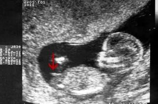 image of a scan with an arrow pointing to a horizontal nub indicating a girl