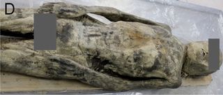 A 17th-century male mummy, called the Andong mummy, who was diagnosed with a diaphragmatic hernia.