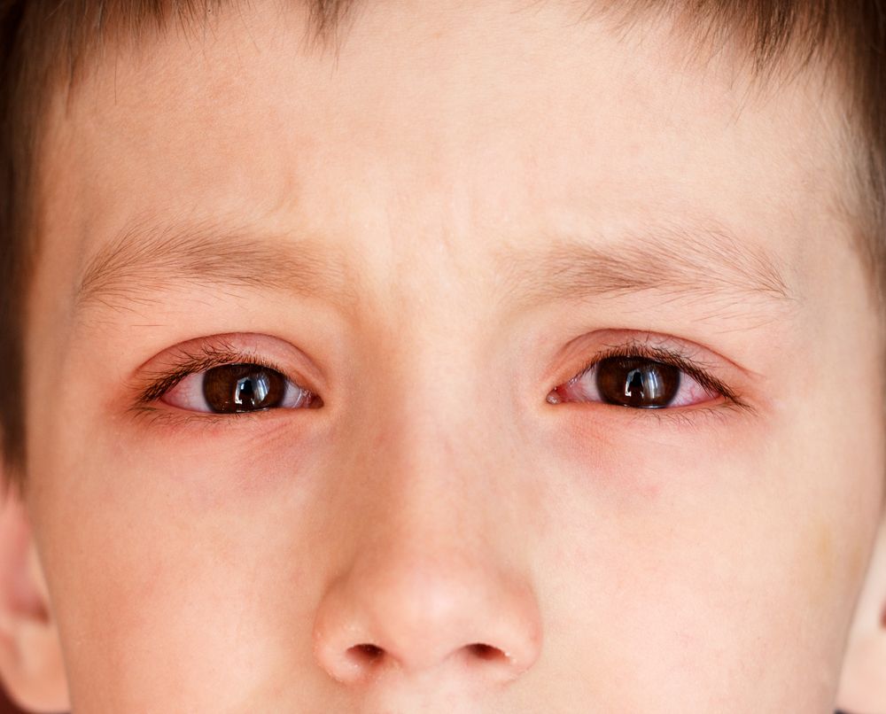 Boy with pink eye