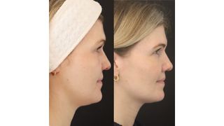 Fiona McKim before and after her ultherapy treatment