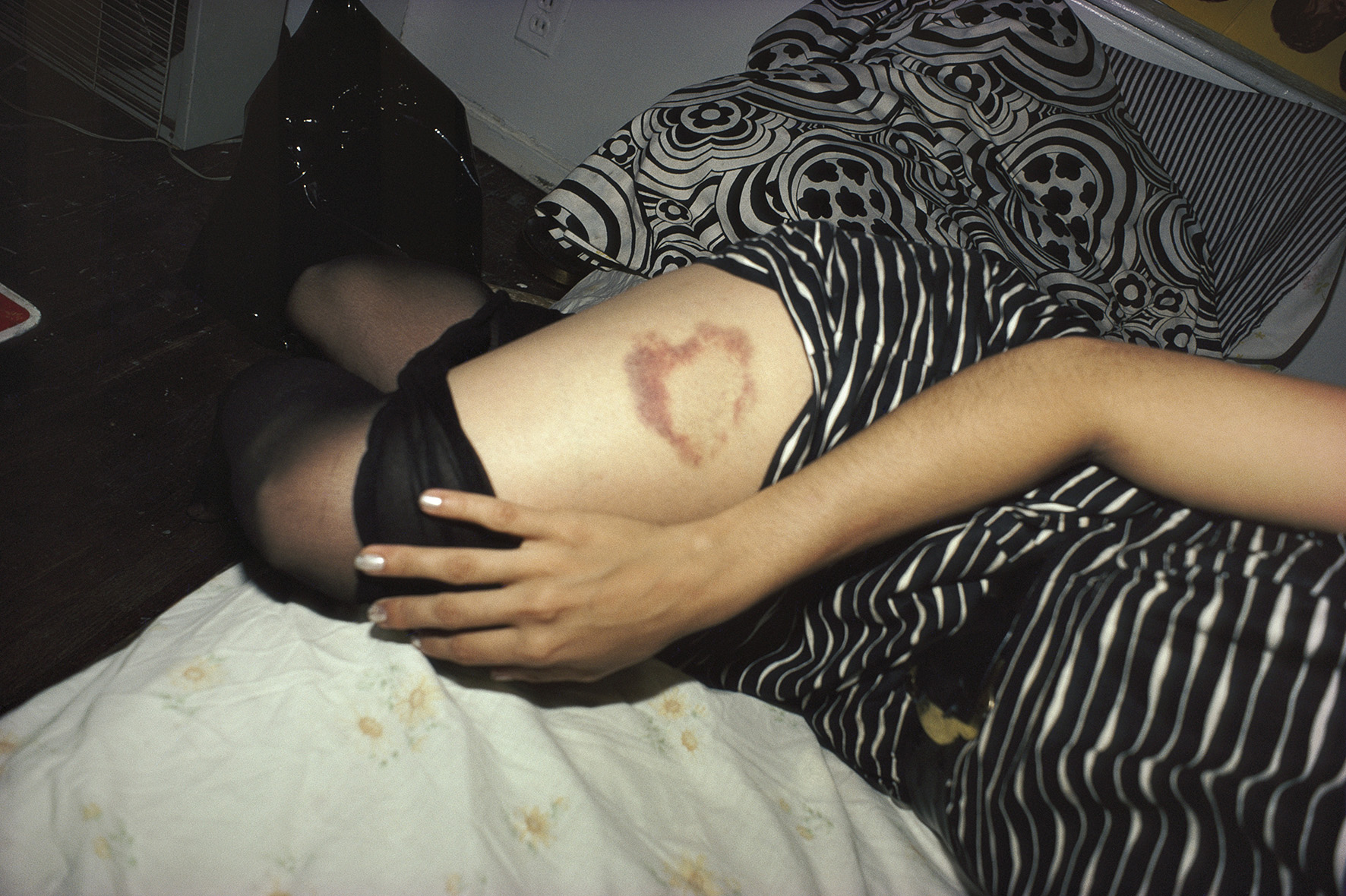 photograph by Nan Goldin showing woman&#039;s bruised leg
