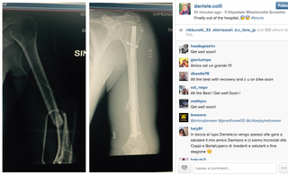 Daniele Colli's broken arm