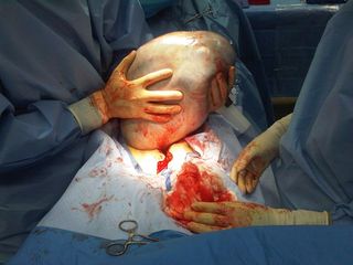 This ovarian cyst, removed by Dr. Jonathan Herman, weighed about 25 pounds (11 kg)