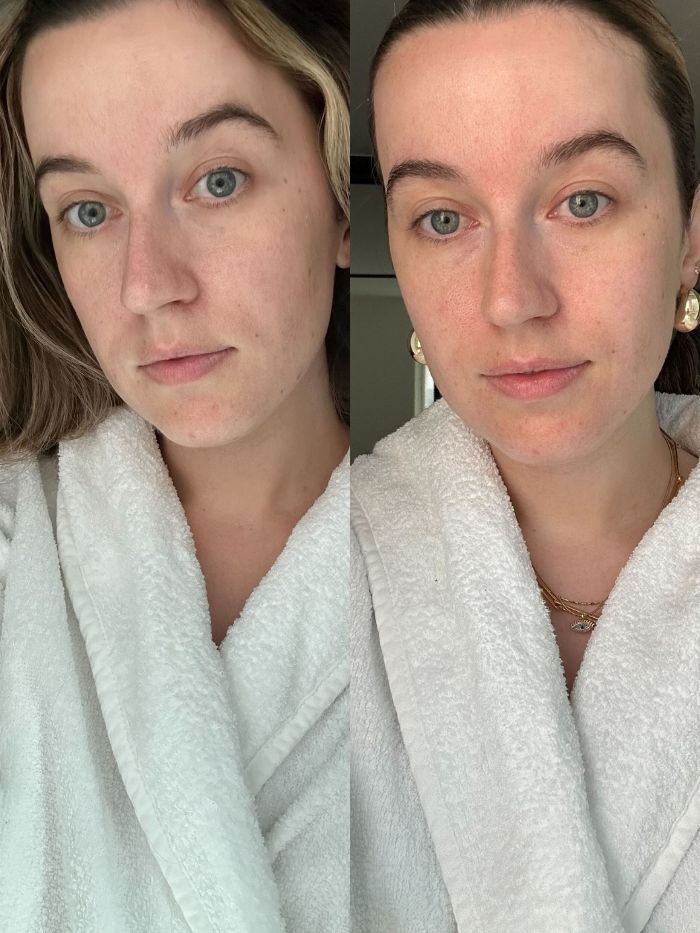 Junior beauty editor, Grace Lindsay, showing her skin before and after testing the Ziip Dot