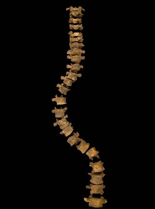 Here the spine of what has been confirmed to belong to King Richard III. The spine shows the king would've had so-called idiopathic adolescent-onset scoliosis, meaning the cause is unclear though the individual would have developed the disorder after age 10; the curvature would've put pressure on the man's heart and lungs and could've caused pain.