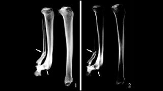 Two x-rays side by side showing the left and right shin bones of a 30-35 year old woman who died about 3000 years ago in China. The bottom right shin bone has been amputated and the x-ray shows some damage here.