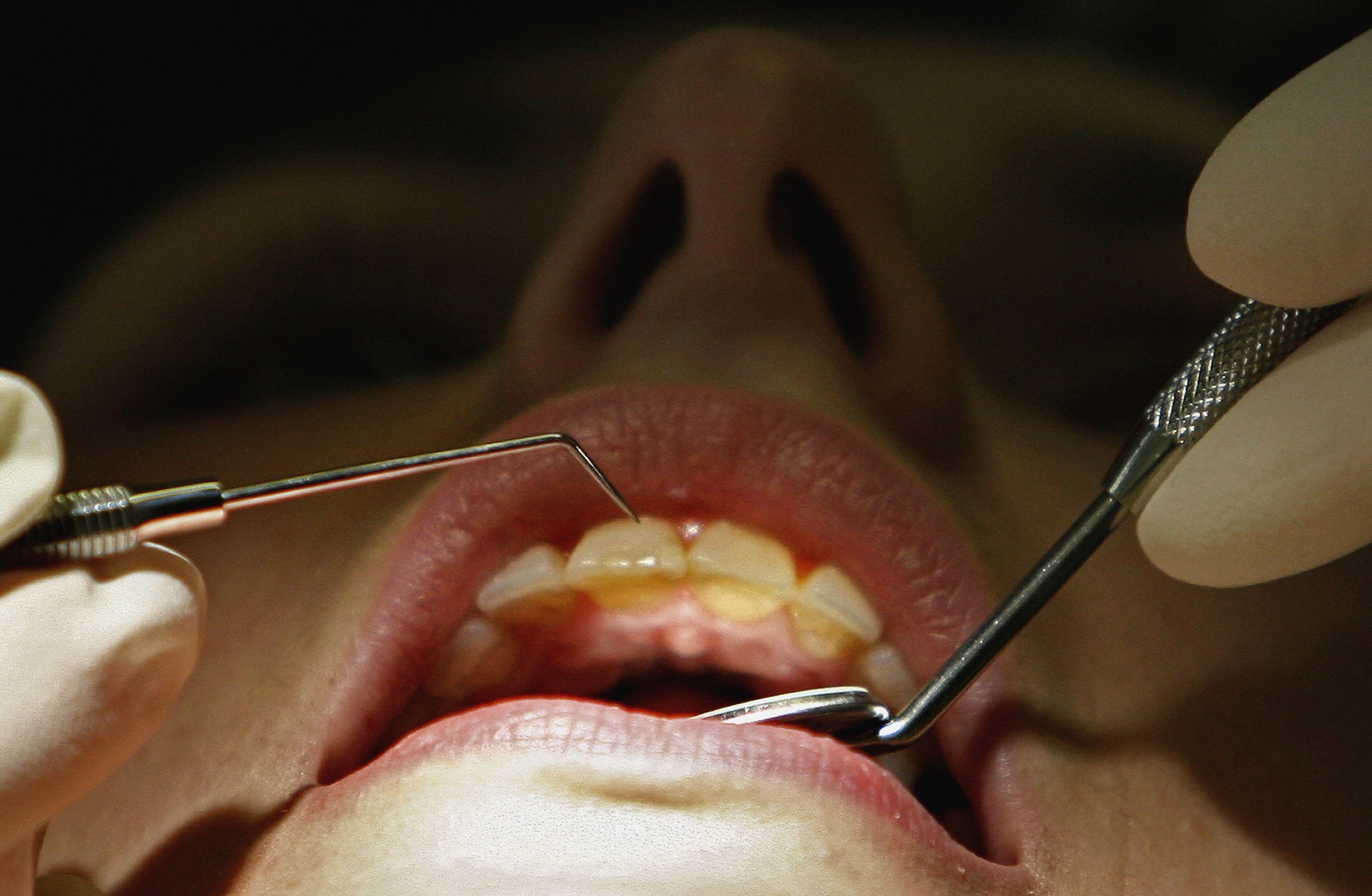 Woman's mouth open at dentist