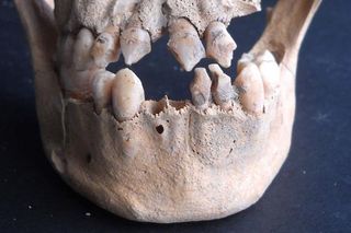 Skull fragment from 17th-century slave