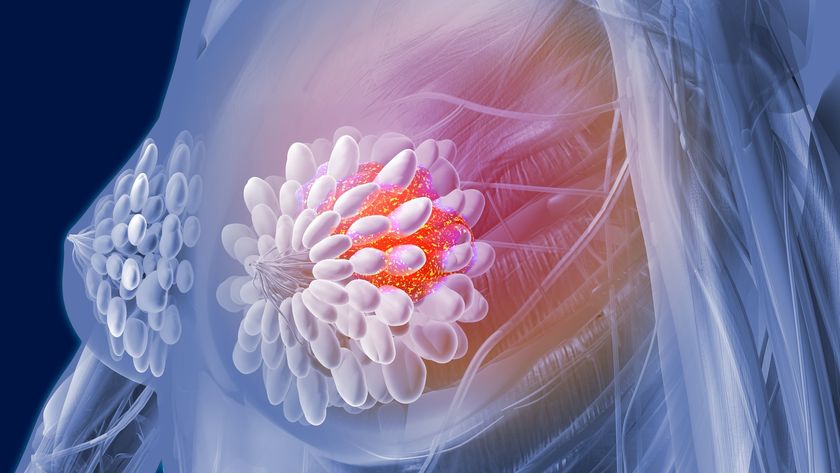 an illustration of cancerous tissue in a woman&#039;s breast