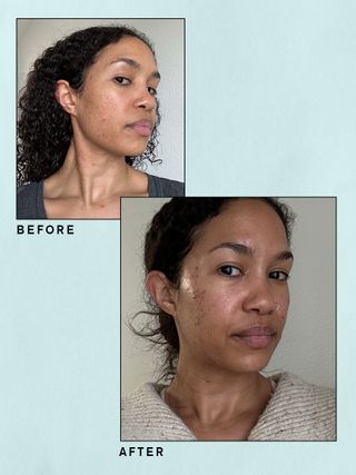 Lyma Laser before and after images from beauty editor Shawna Hudson.