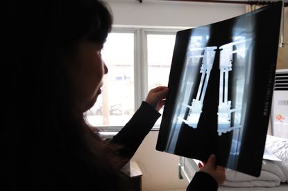 TO GO WITH AFP STORY "Health-China-lifestyle,FEATURE" by Pascal Trouillaud Former patient Wang Lijun, now working at the clinic, looks at an X-Ray of another patient who recently has his legs