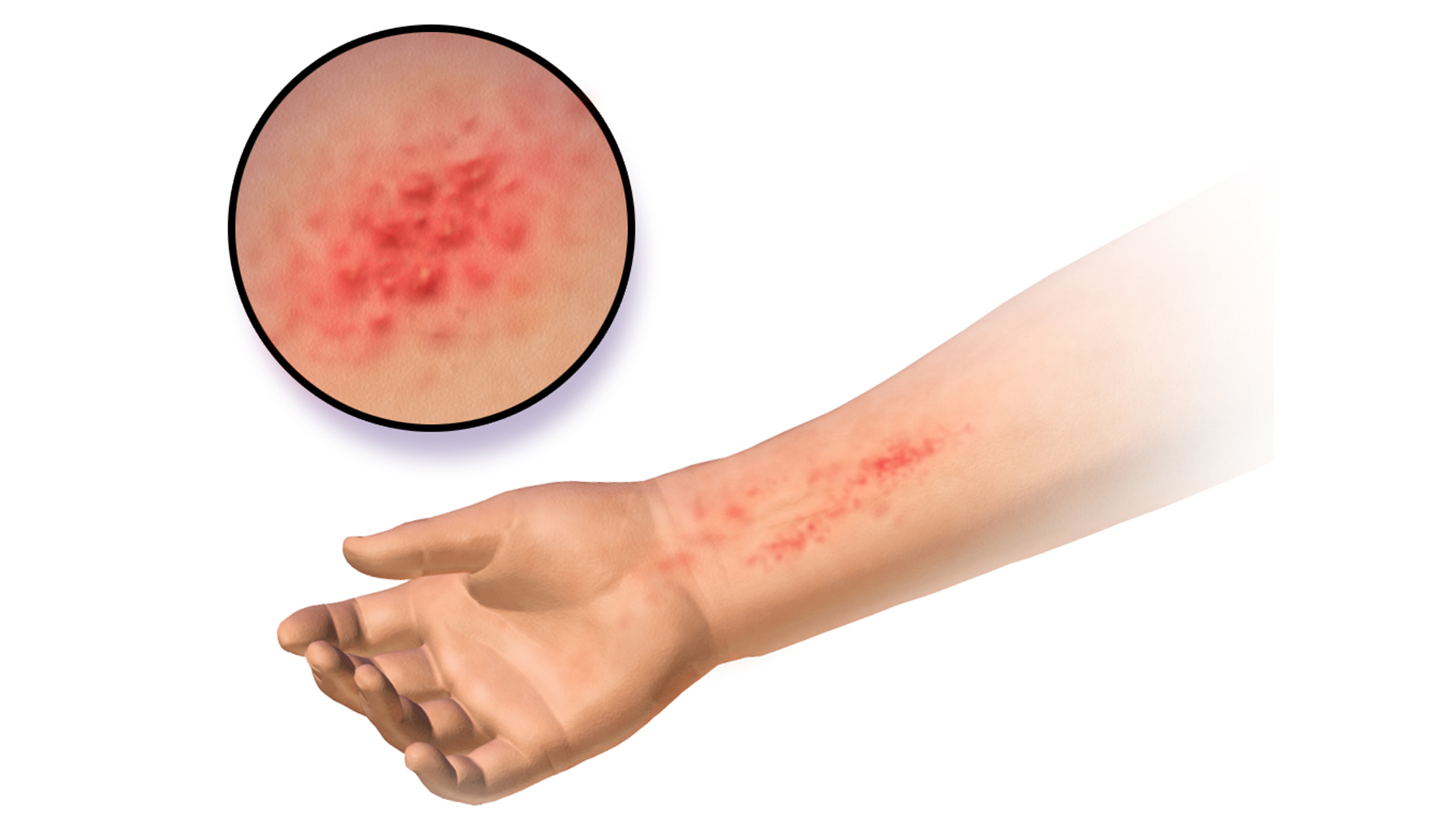 Illustration shows a red, bumpy rash on a fair-skinned person's arm