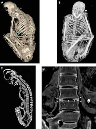 ct scans of an incan mummy body