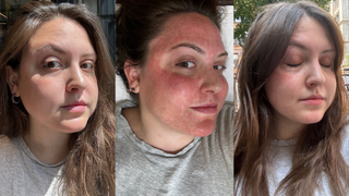 Sophia Vilensky's skin before, immediately after, and one week after microneedling.